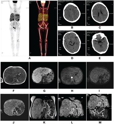 Case Report: CTC1 mutations in a patient with diffuse hepatic and splenic hemangiomatosis complicated by Kasabach–Merritt syndrome